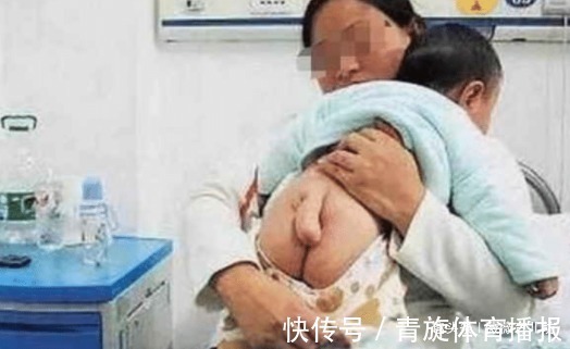 脊髓栓系综合征|半岁男宝竟长出了“小尾巴”，送医院检查后，医生怒骂宝妈太无知