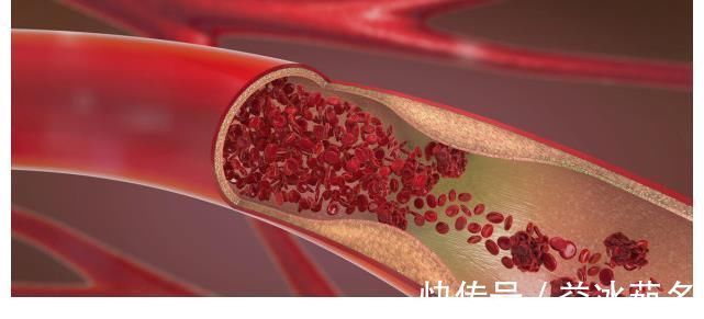退休|退休院士亲历:甘油三酯3.6,戒掉两种食物以后,血脂慢慢稳定了