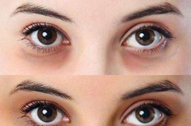 黑眼圈时间久了就会有种困乏感,怎么才能祛除这些呢?赶紧来看