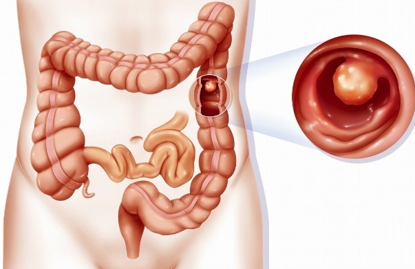 假性腹泻|肠癌早期不明显提醒这4种“迹象”或是肠癌的前兆,留心一点