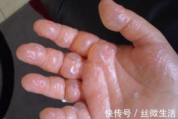 古人|这种农村野外的“毒草”，一碰就三级烧伤？古人还用它治疗白癜风