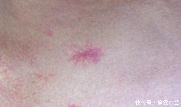 凝血功能|肝病大多是“拖”出来的,皮肤出现3种改变,多半是肝在“求救”