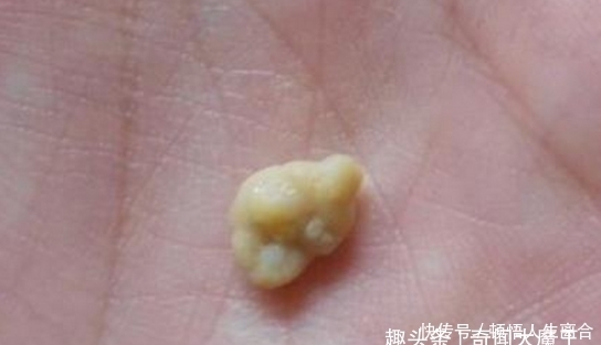 鼻子|女子口臭多年,到医院就诊,医生捂住鼻子,从嘴里抠出块臭石头