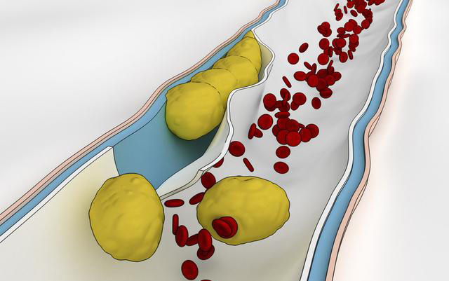 高密度脂蛋白|血脂升高可以说是现代人多种疾病的起源，有什么办法能够降低血脂