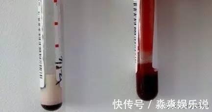 他汀类降脂药|高血压患者只服用降压药还不够,这两类药也很重要