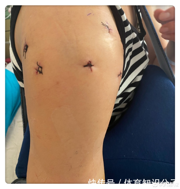 右肩|女排老将颜妮动手术!历时6个半小时,肩膀打进8颗钢钉