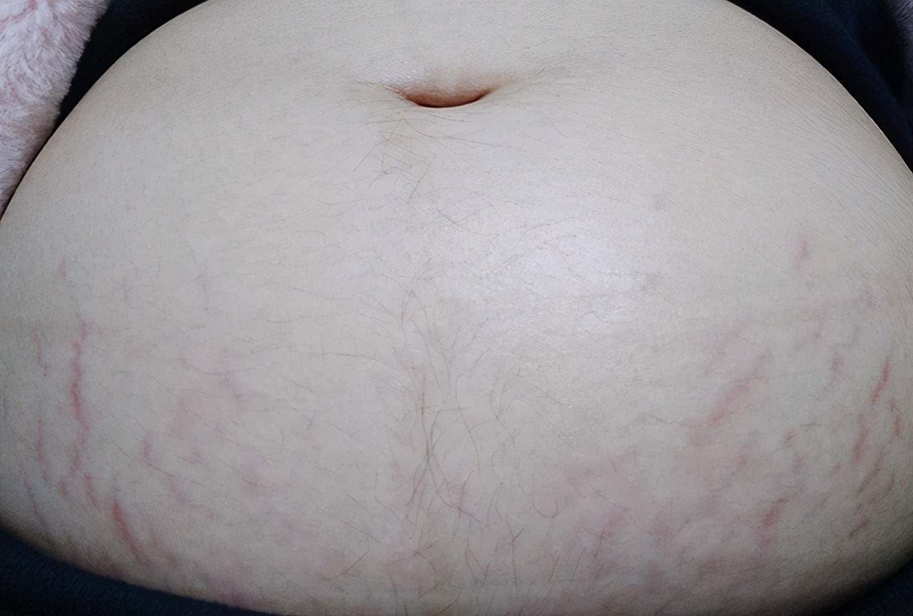 小丽|怀孕后,为啥有人会长妊娠纹,有人却不会长和这四个因素有关