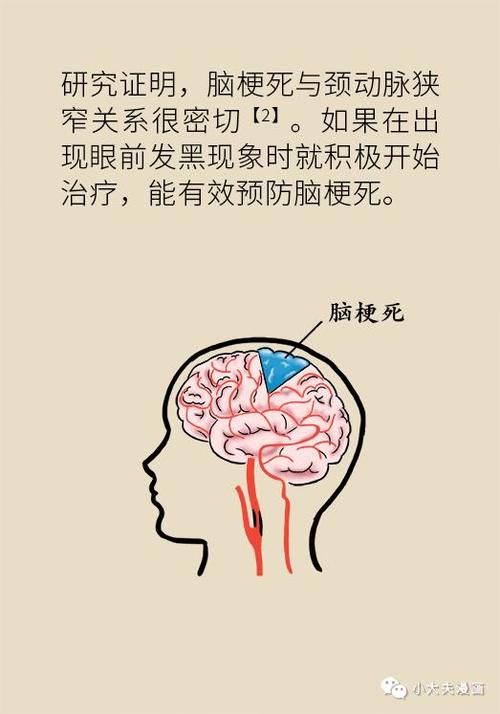 眼前发黑，可能是大脑在求救，高危人群需尽早排查脑梗风险