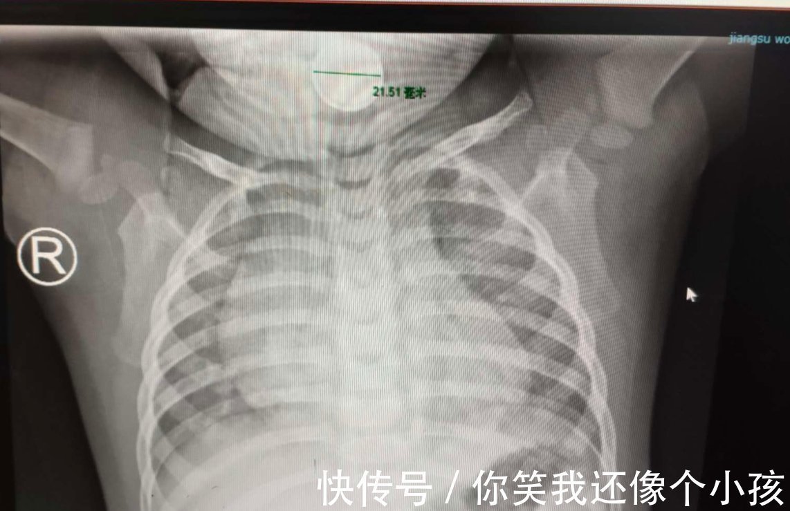 吞食|2岁娃一个动作,7天后住院动了手术,孩子的这种行为家长要警惕