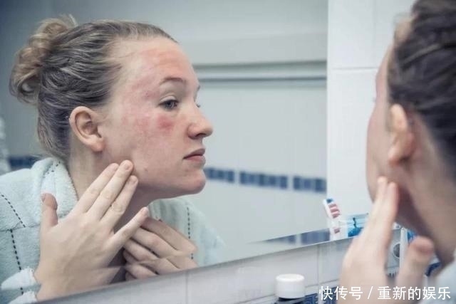 ige|人人逃不开的过敏,竟然还与癌症有关