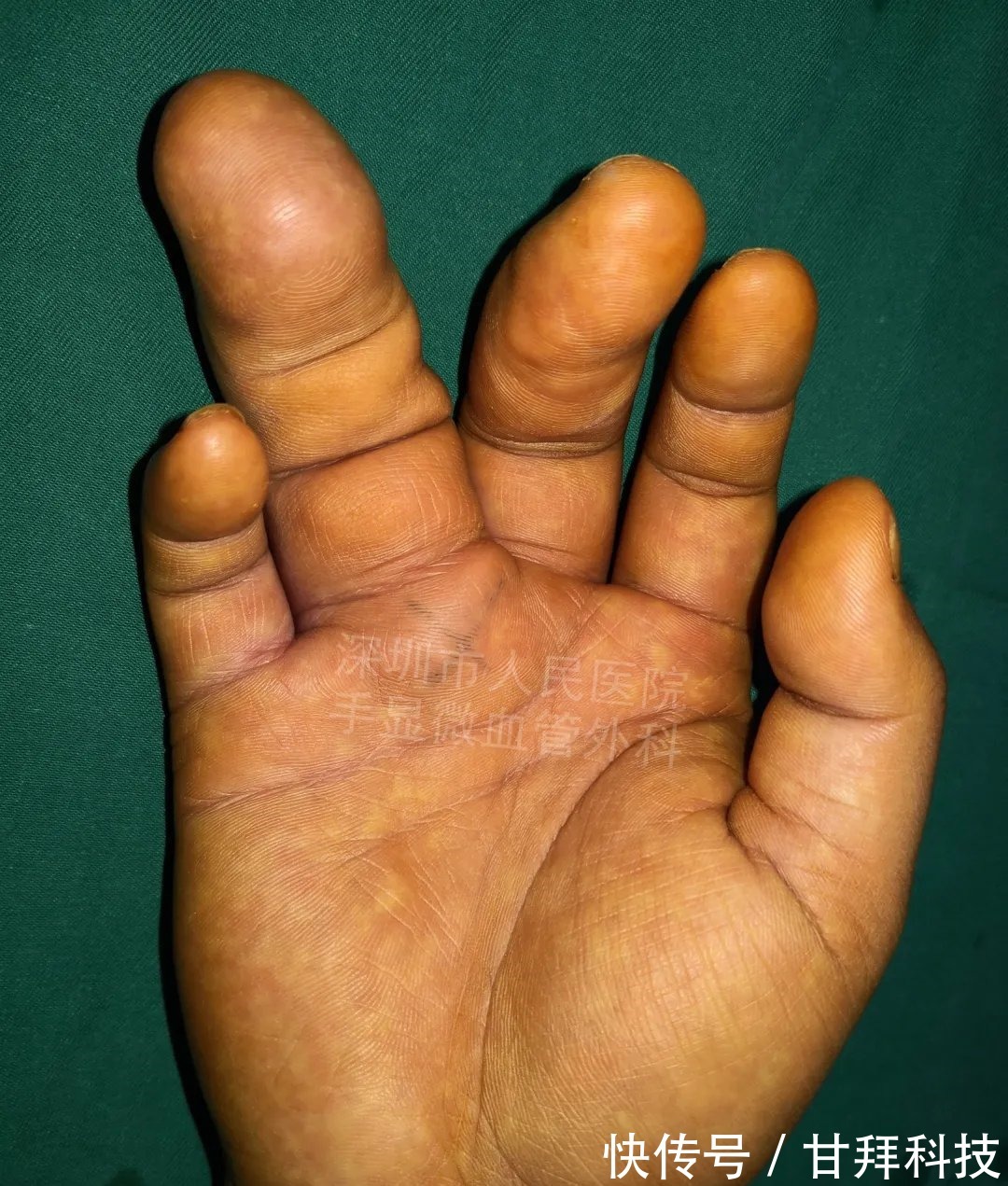 男孩|得了这病，12岁男孩手指比香蕉还粗！7种常见的手部畸形，家长们要注意