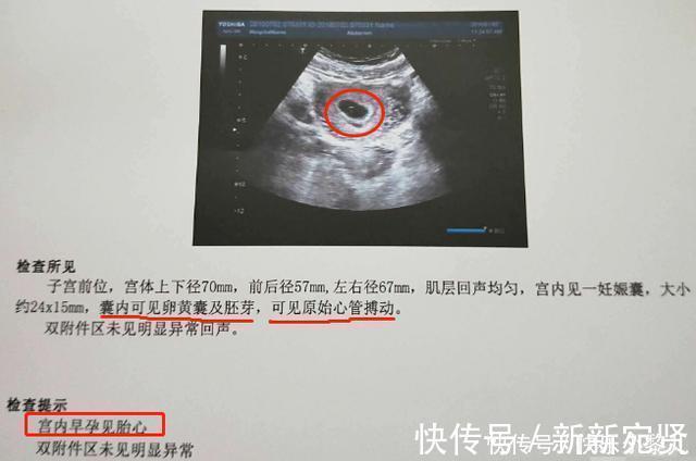 着床|怀孕B超检查太早没意义,太晚又天天担心,而这个孕周刚好!