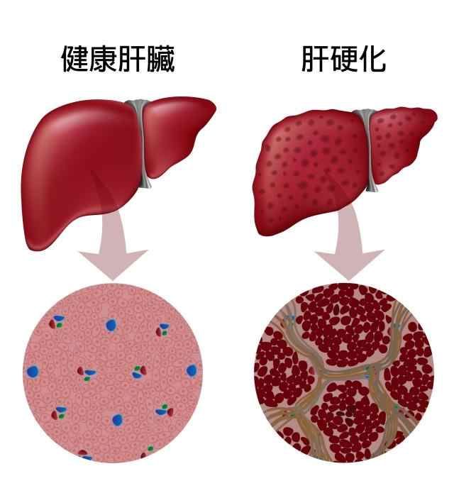 肝硬化，身体先知！身体若出现三种“情况”，或是肝脏已不健康