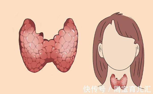 恶性|甲状腺结节分等级,发展到几级会成为癌症?甲状腺可以自愈吗?