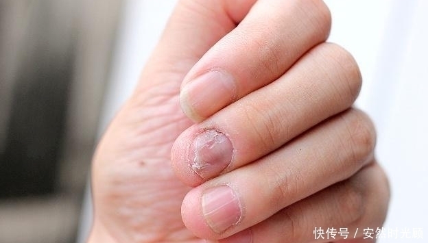 指甲盖|手指甲为什么会出现“竖纹”?这4个原因,最好了解一下!