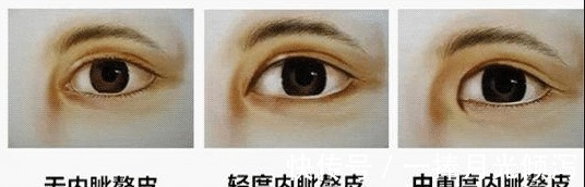 内眦赘皮 开眼角手术怎么做才能不留疤隆鼻能改善眼角吗!
