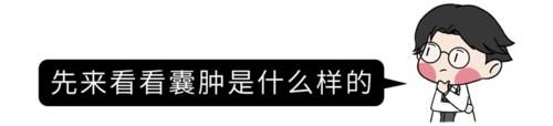 体检查出的囊肿，到底是什么？会有什么危害吗？和肿瘤有什么区别？