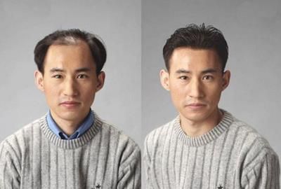 种植|天生发际线高还有救吗?试试发际线补发和自体头发种植,非常实用