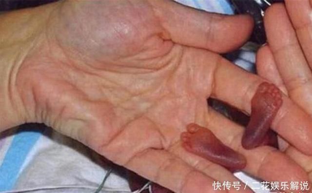 准妈妈|世界最小的婴儿已经14岁了,如今的现状,生活得有滋有味