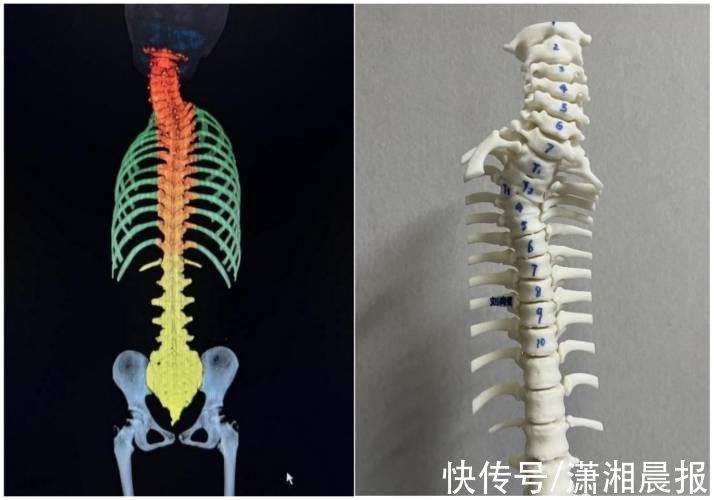 天玑|湖南省首例！“天玑”机器人辅助先天性脊柱侧弯矫形手术顺利完成