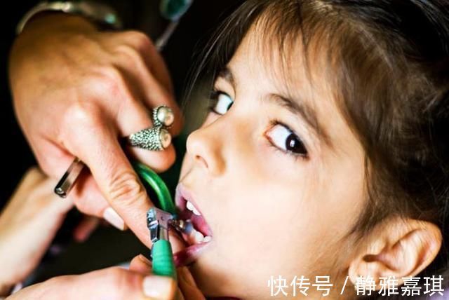 牙齿|10个5岁儿童中,7个有龋齿,罪魁祸首居然不是糖?