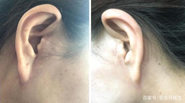缝线 求美者说52岁,做完拉皮手术后的90天