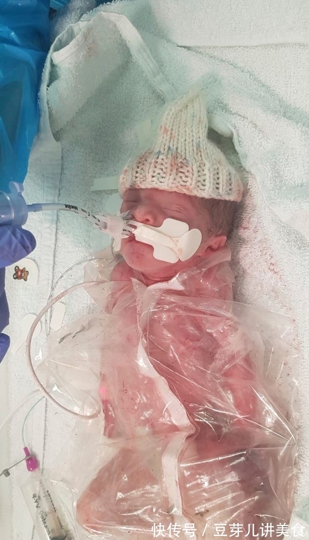 里菲特|早产3个月的龙凤胎迎来生日,为模仿妈妈的子宫曾被裹在食品袋里