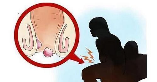 红薯|肛门有个“小肉球”,是痔疮吗?3个方法缓解多年老痔疮