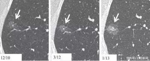 定时炸弹|「双语」人体内的＂定时炸弹＂