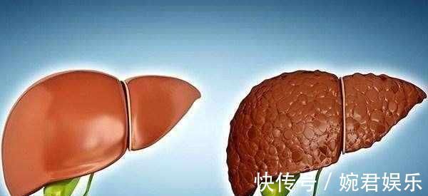 肝脏|出现三种信号,可能是肝硬化上门,四种食物尽量戒掉吧,很伤肝!
