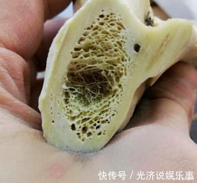 成骨细胞|花生是骨质疏松的发物?医生:不想骨头成蜂窝,3种食物尽量远离