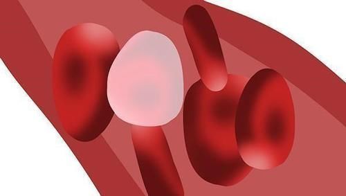 导致|39岁男子从查出高血脂到脑梗,仅用半年,医生血脂高需避开3物