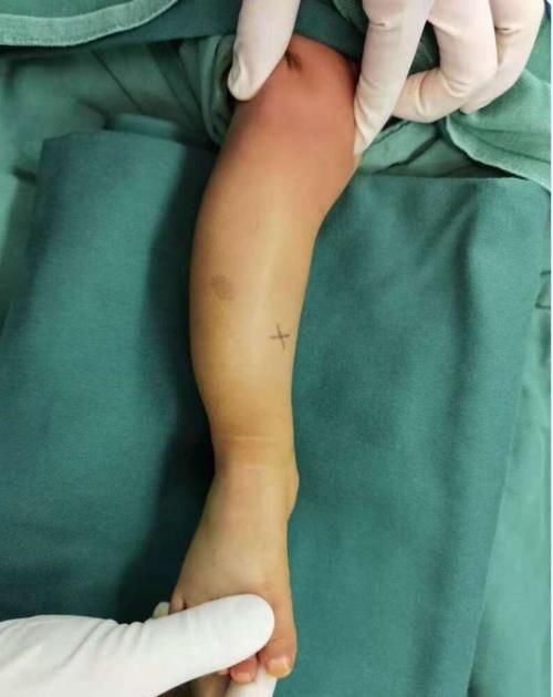 救女|2岁女儿 骨折查出罕见病，90后妈妈取骨救女，只要孩子能站起来