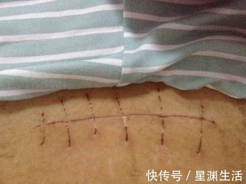 妈妈|“假如能重来我要选顺产”,95后妈妈的哭诉,道出剖腹产背后辛酸