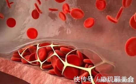 静脉血栓|身体有“血栓”，手脚会告知！一旦手脚出现3种异常，抓紧防血栓