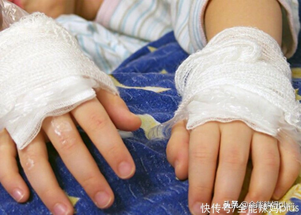 水泡|4岁娃掉入170度油锅,奶奶3步救下孩子,医生:比我内行