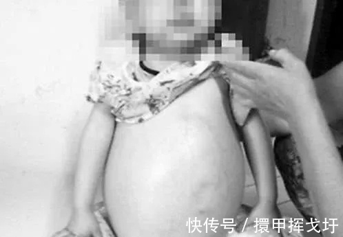 良性|7岁小女孩“怀孕”,医生取出“胎儿”后,父母怀疑自己的眼睛。
