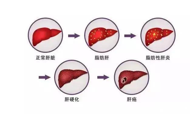 毁肝第一名不是酒精？是你每天都在做的这些事