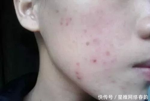 炎症|应该先去以前的旧痘印,还是先去新长出来的痘痘?