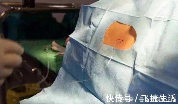 后遗症|剖腹产麻醉后,产妇有啥感觉,看经历过的妈妈们怎么说