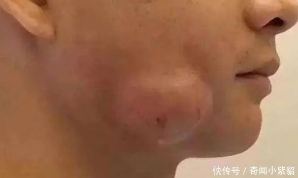 小伙|小伙经常熬夜,脸颊突发的就肿了起来,到了医院检查完让人不淡定