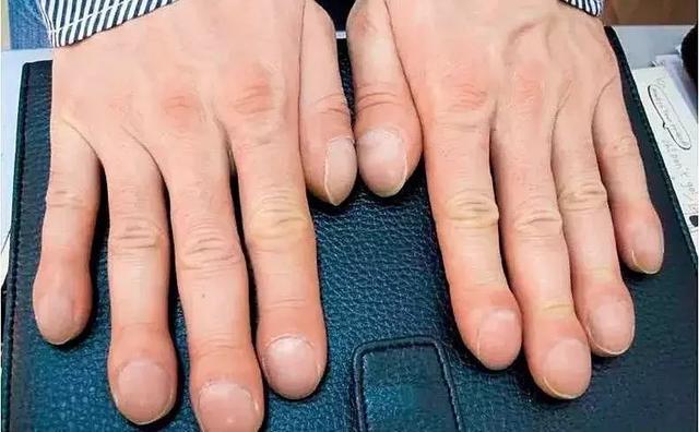 老李|46岁男子,不痛不痒,查出肺癌,手上1个标记,提示已到中晚期