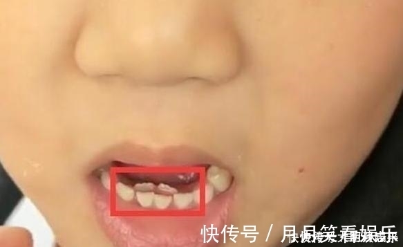 喂养|10岁男孩长出“双排牙”,父母送医检查,医生家长喂得太精细