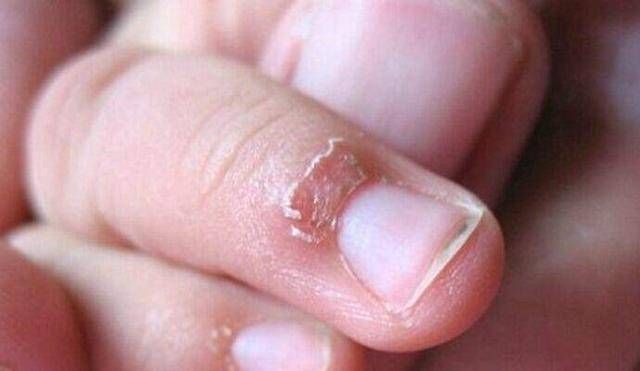 宝妈|缺锌的孩子，身体主要有这6个反应，家长可别疏忽了！