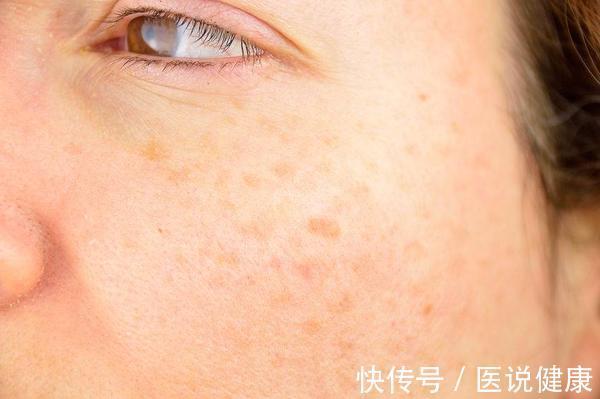 皱纹|面部若出现这5问题,皮肤或开始衰老了,若你有,该做保养了