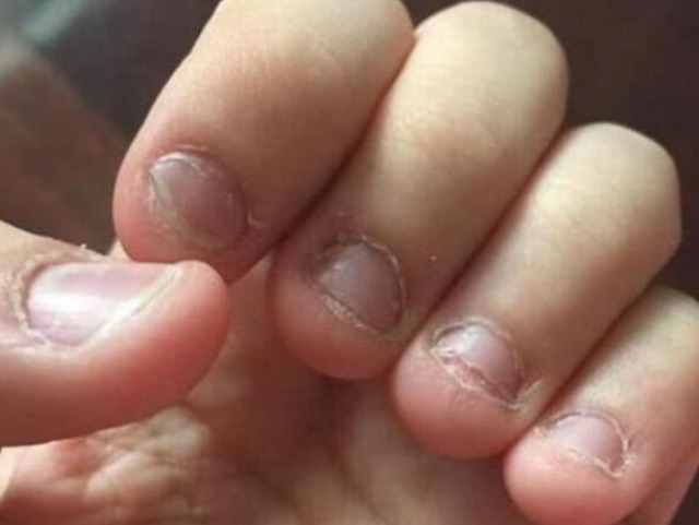 咬指甲|从小爱“咬指甲”的孩子,医生坦言长大后,多半逃不过两种结局