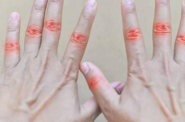 高尿酸血症|痛风有多“容易”?这5件事你每天都做,痛风或“缠”着你不放