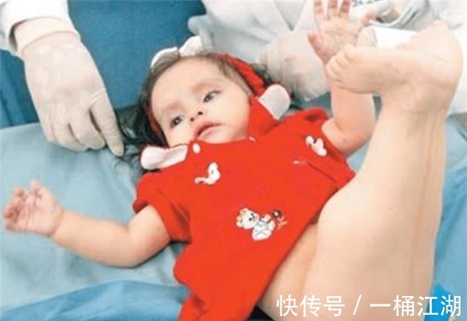 双腿|美国女孩出生患美人鱼症,喜欢在水里,生存十年创造医学奇迹