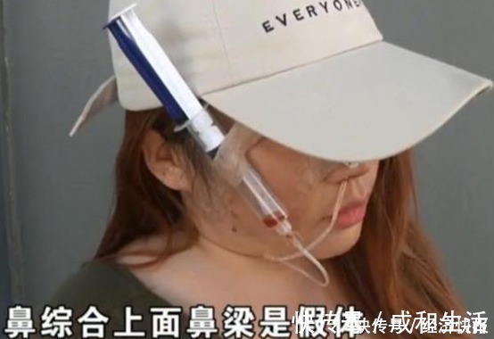 假体|女子高价整容,脸上挂满“注射器”,医院:赔你点吧