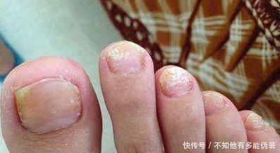 征兆|脚上出现这5种症状, 是大病征兆, 再不注意就晚了!